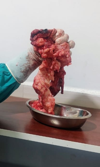 Bade Fibroid ka Operation Laparoscopic Fibroid Surgery